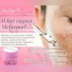 Her Choice Ph Pekas Remover Cream – 50g